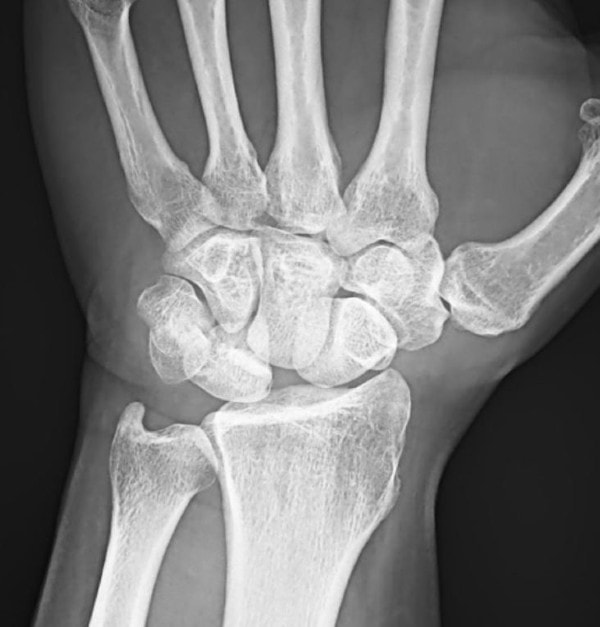27-year-old wrist Paid After A Fall XR Image 