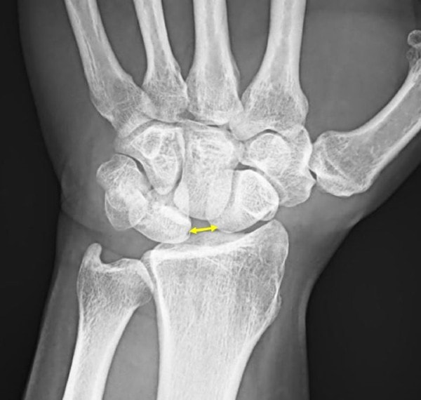 27-year-old wrist Paid After A Fall XR Image with Resolution
