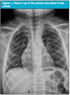 Chest X-Ray of patient that presents to the urgent care after nonfatal drowning.
