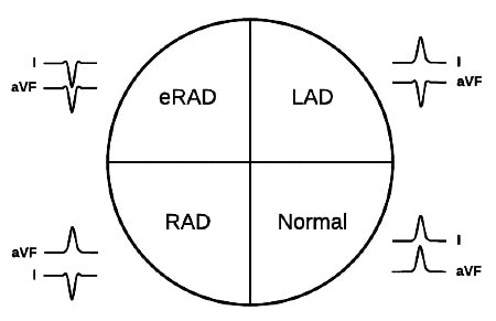 ECG review of  LAD, left axis deviation; RAD, right axis deviation; eRAD, extreme right axis deviation