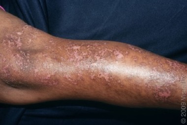 A 71-Year-Old with Diabetes and Discoloration of the Skin