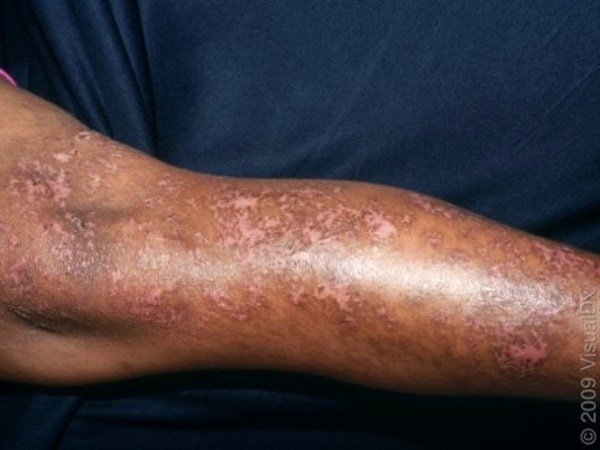 A 71 Year Old With Diabetes And Discoloration Of The Skin Journal Of