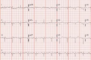 A 57-Year-Old Female with Cardiological History and Shortness of Breath