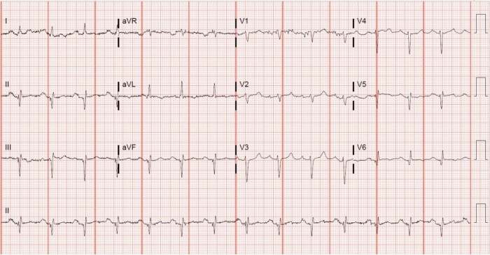 ECG Case of Left axis deviation (LAD)