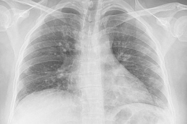 A 31-Year-Old with Cough and Decreased Breath Sounds