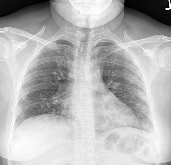 notice the Patchy peripheral infiltrates. could be atypical COVID or Multifocal unilateral pneumonia