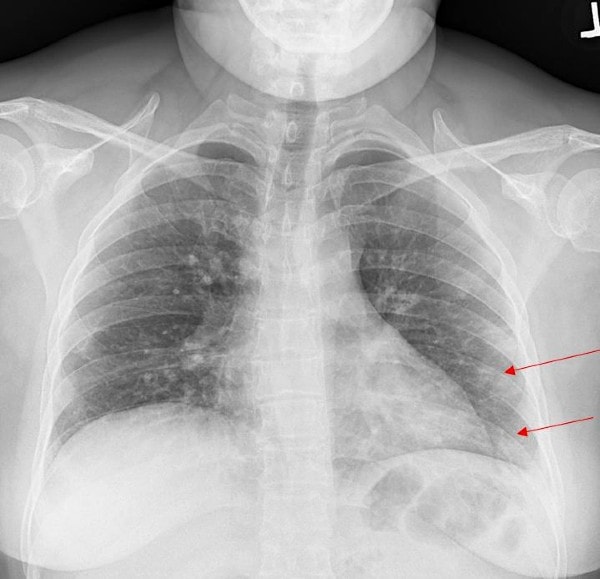 XR Resolution - multifocal unilateral pneumonia