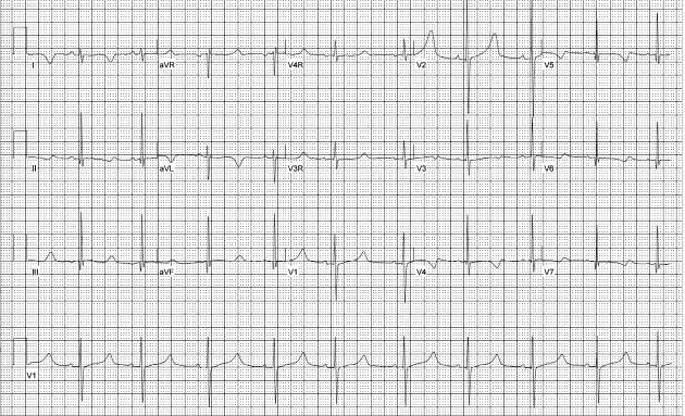 EKG in an adolescent male showing a normal sinus rhythm. syncope in pediatric patients