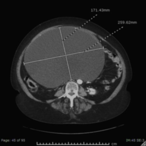 Ovarian Mass Axial image