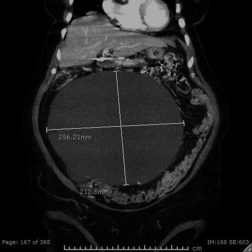 Ovarian Mass Coronal image