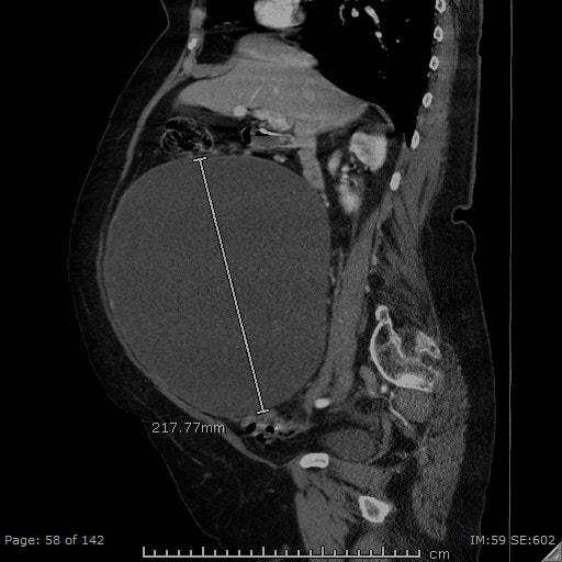 Ovarian Mass Sagittal image