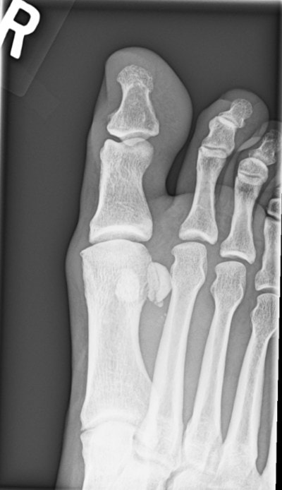 Chronic fragmentation of the sesamoid, hallux pain, joint Pain, Reoccurring Metatarsophalangeal Joint Pain