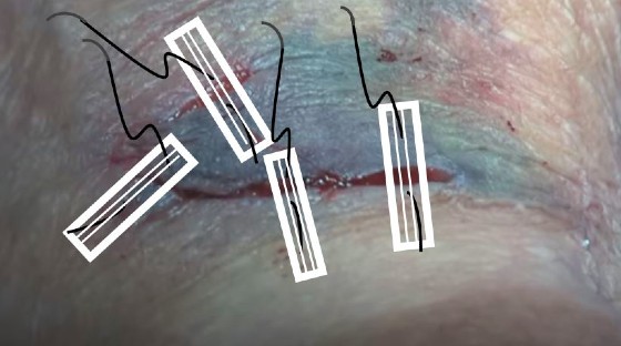 Lacerations in the Elderly Patient