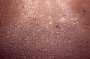 A 7-Year-Old Boy with Scaly Red-Brown Papules on His Trunk