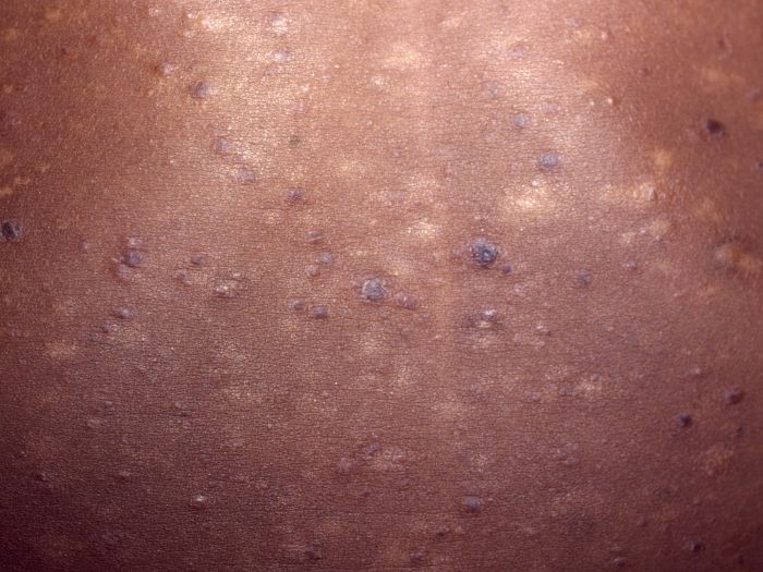 Scaly Red-brown papules Image