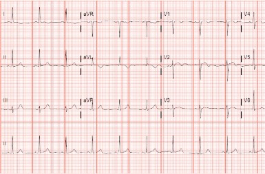 A 61-Year-Old Woman with a 2-Day History of Chest Pain