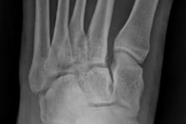 A 28-Year-Old with Foot Pain After a Fall