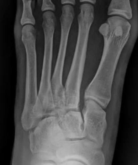 Clinical Challenges 28-Year-Old with Foot Pain X-Ray