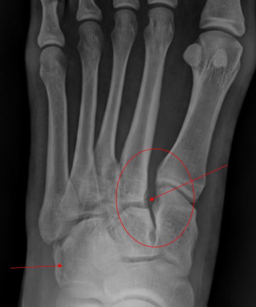 Clinical Challenges - 28-year-old with Foot Pain x-ray, the resolution