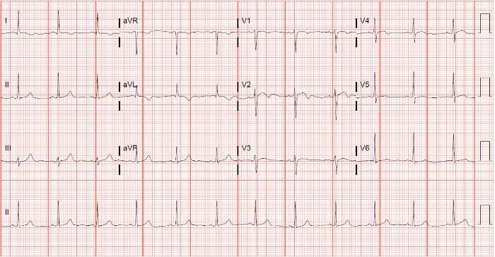 Clinical Challenges - ECG 2-Day History of Chest Pain