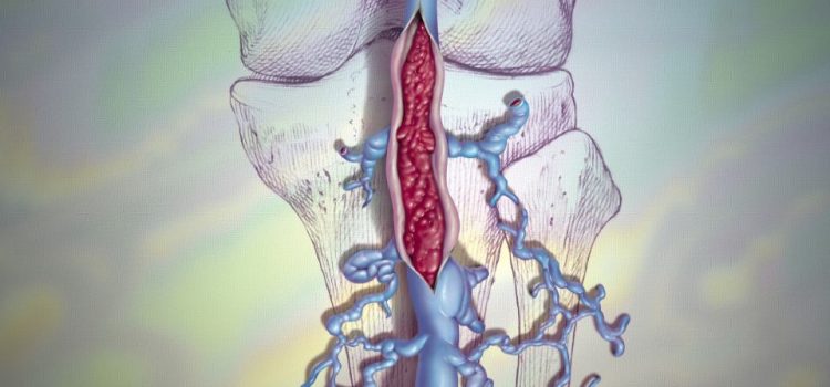 Urgent Care Diagnosis and Management of Deep Vein Thrombosis