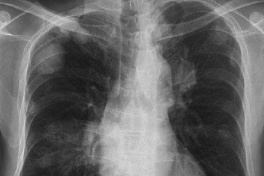 A 75-Year-Old with Chest Pressure