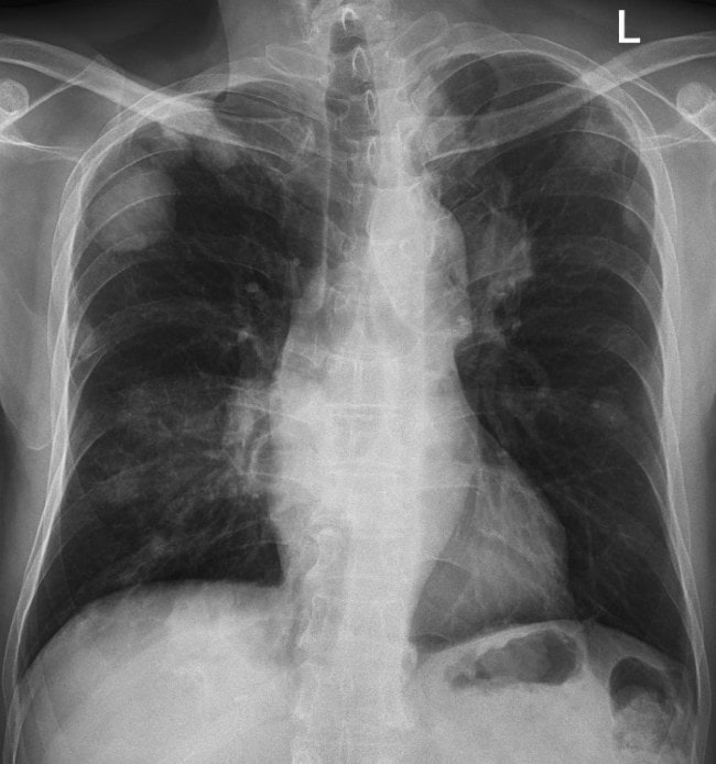 74-year-old male with metastases