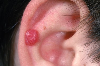 A 6-Year-Old Boy with a Lesion on His Ear