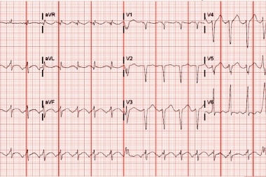 A 65-Year-Old Man with Shortness of Breath and a History of Heart Failure