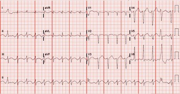 65-year-old with shortness of breath ECG