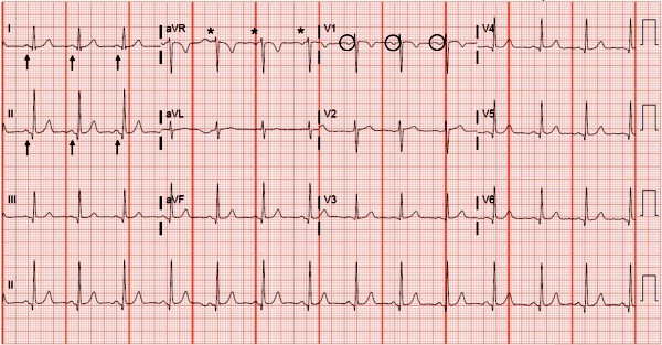 65-year-old with shortness of breath ECG and issue pointed out