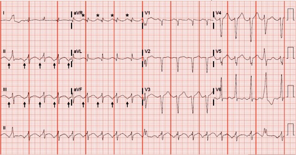 65-year-old with shortness of breath ECG and issue pointed out