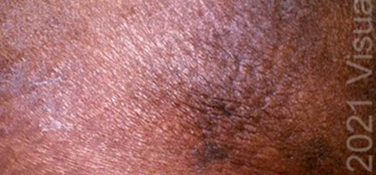 A 60-Year-Old Woman with Dark, Painful Plaques on Her Legs