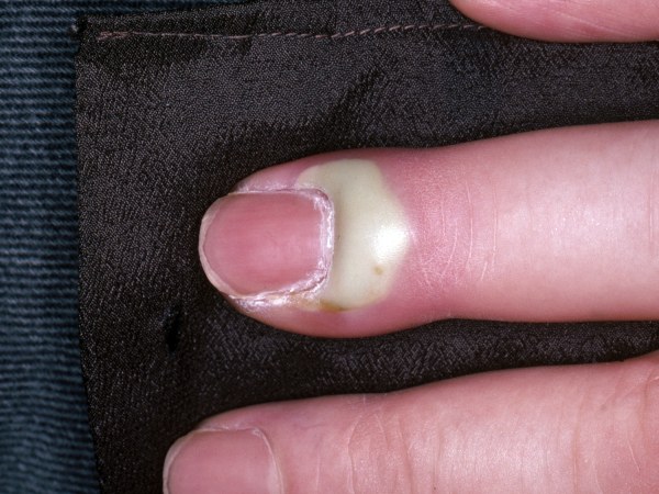 Painful, Purulent Finger
