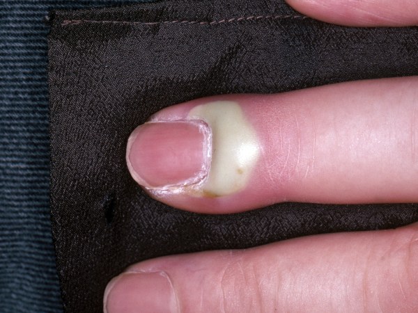 More About Why do I have swelling in my hand?