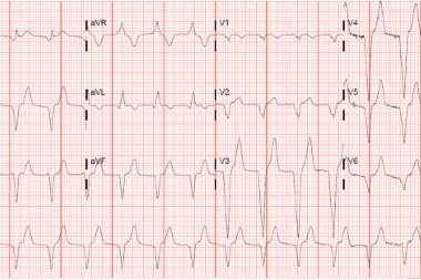 A 36-Year-Old Male with Sudden-Onset Substernal Chest Pain