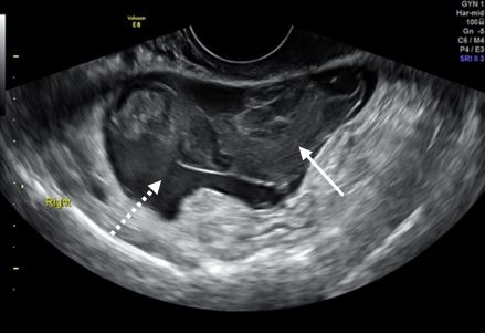 Ultrasound - Transvaginal image showing Blood Clot