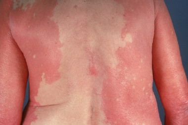 A 68-Year-Old Woman with a Rash of Several Weeks’ Duration