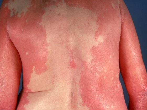 68-Year-Old Woman with a Rash of Several Weeks’ Duration