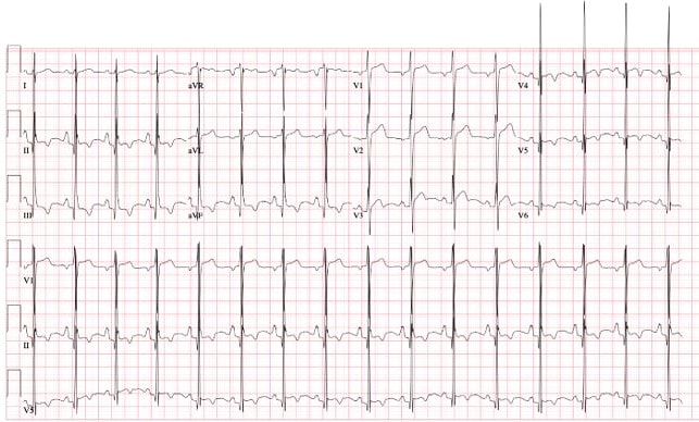 27-year-old with chest pain