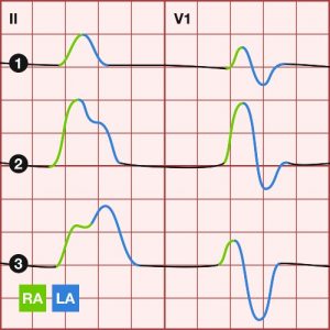 27-year-old with chest pain ECG Figure 2