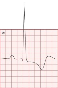 ECG 2 - V6