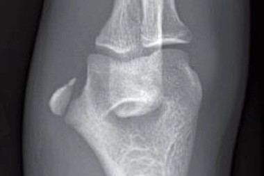 A 15-Year-Old Boy with a Painful Elbow After a Baseball Game