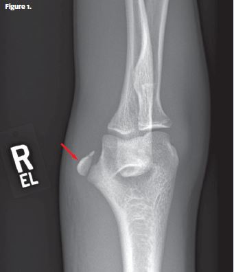 X-ray resolution - significantly displaced avulsion fracture of the medial epicondyle