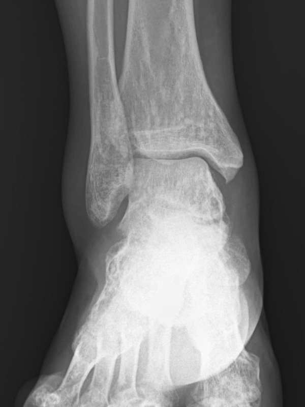 Pain After Twisting Ankle X-ray 1