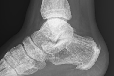 A 47-Year-Old with Pain After Twisting His Ankle