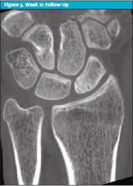 Figure 5 - Week 21 Follow-Up on Scaphoid Injury