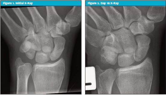 Figure 1 & 2 - Initial X-Ray of Scaphoid