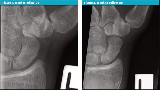 Figures 3 & 4 - Week 8 and Week 18 Follow-Up of Scaphoid Injury