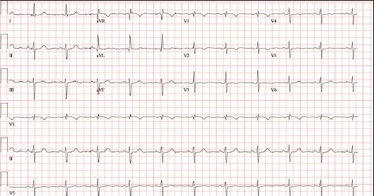 ECG of a recent syncope event 